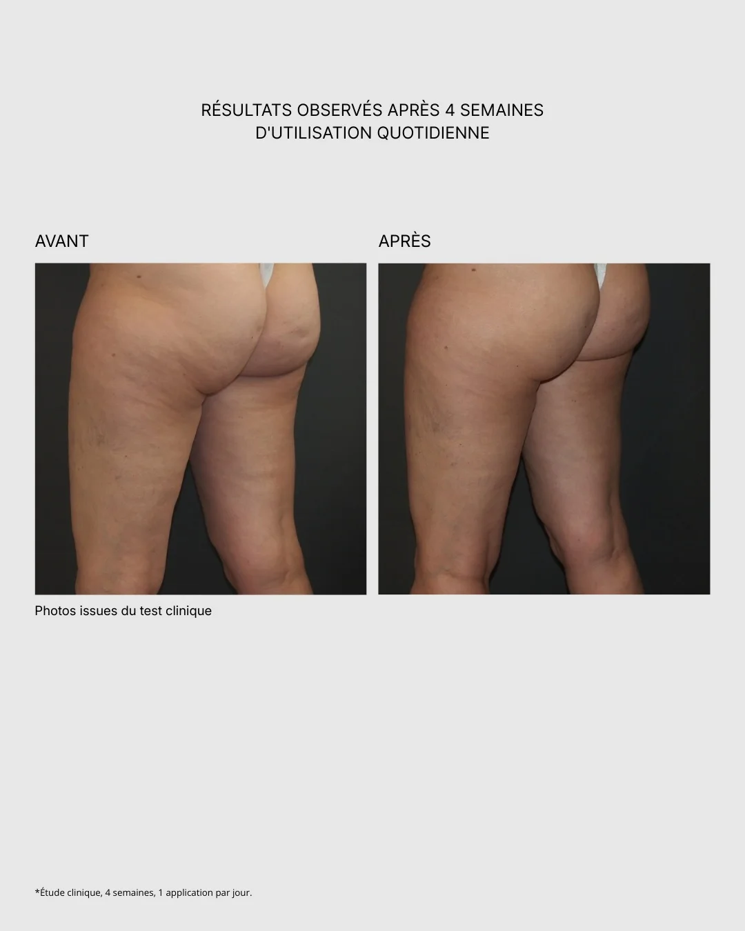 Bioslimming : résultats observés après 4 semaines d'utilisation quotidienne, photos issues du test clinique